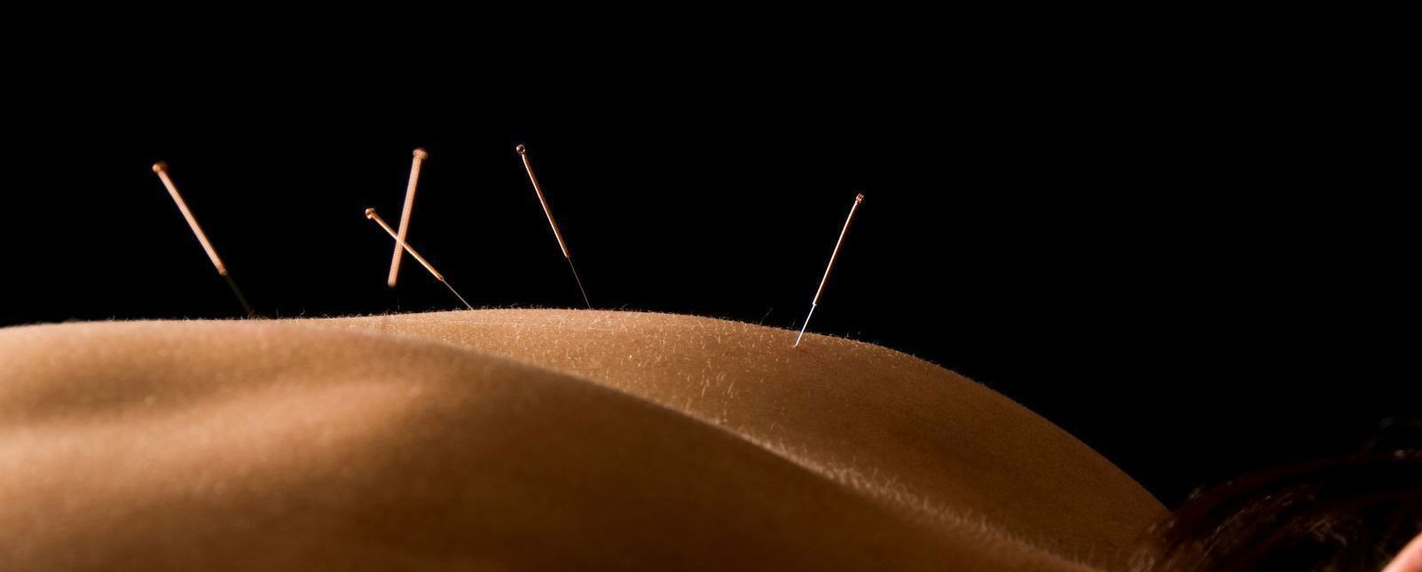 Acupuncture: Not Just for Pain…