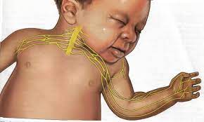 Plexo Braquial Neonatal