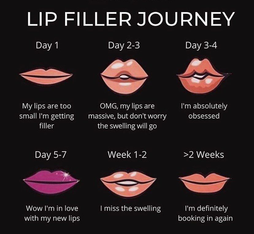 Lip Filler Journey