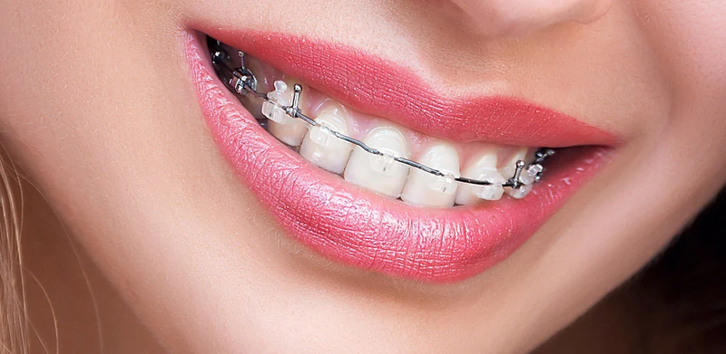 Dental Braces