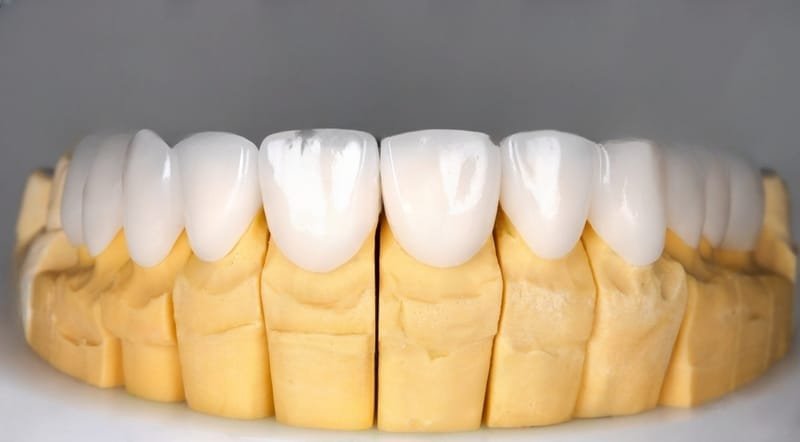 Ceramic Dental Veneers