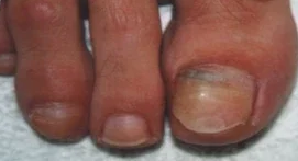 Blauwe nagel