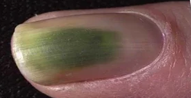 Groene nagel