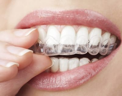 Facts about Invisalign image