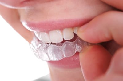What is Invisalign? image