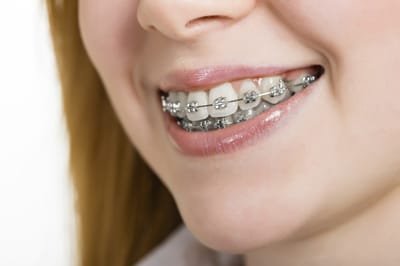 Getting Braces for Your Teeth image